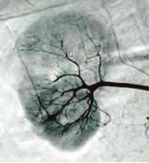 The role of transanterial embolization of the renal cell carcinomas (RCC) in elderly Figure 3 (Α, Β): Selective right kidney digital ablative angiography of the renal metastasis in the right kidney