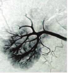 Post-chemoembolization image exhibits the almost complete elimination of lesion vascularization A B A B C Figure 4 (A, B, C): Selective right renal artery angiography in two right kidney RCC sites