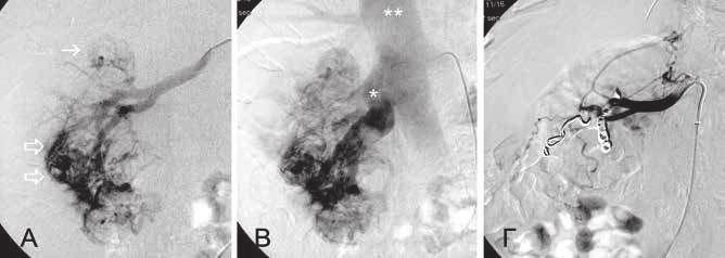 The early arterial phase reveals pathologic vascularization with new spiral vessels, more evident in the sizeable lower pole tumor (empty arrows) and subtle in the smaller upper pole tumor (arrow).