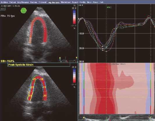 Διδιάστατη παραμόρφωση (2D strain) H διδιάσταση παραμόρφωση επιτρέπει 1) πρωιμότερη ανίχνευση της υποκλινικής συστολικής δυσλειτουργίας σε ασθενείς με