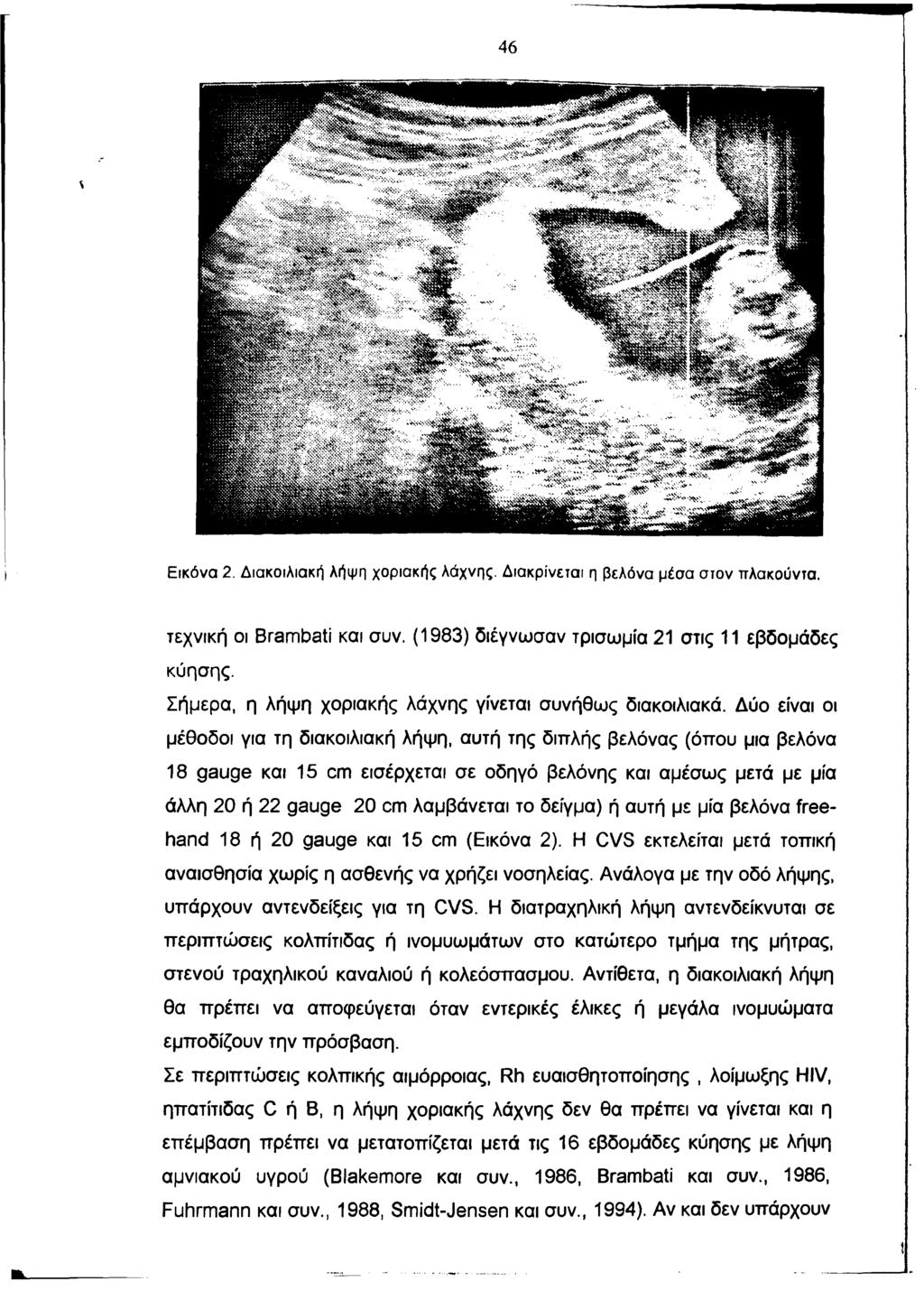 4 6 Εικόνα 2. Διακοιλιακή λήψη χοριακής λάχνης. Διακρίνεται η βελόνα μέσα στον πλακούντα. τεχνική οι Brambati και συν. (1983) διέγνωσαν τρισωμία 21 στις 11 εβδομάδες κύησης.