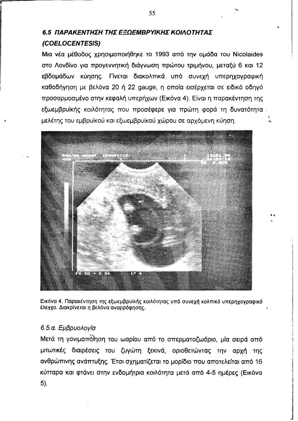 55 6.5 ΠΑΡΑΚΕΝΤΗΣΗ ΤΗΣ ΕΞΩ ΕΜ ΒΡΥΙΚΗΣ Κ Ο ΙΛΟ ΤΗ ΤΑ Σ (COELOCENTESIS) Μια νέα μέθοδος χρησιμοποιήθηκε το 1993 από την ομάδα του Nicolaides στο Λονδίνο για προγεννητική διάγνωση πρώτου τριμήνου,
