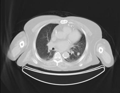 Lesion Characterization 84 year old man with