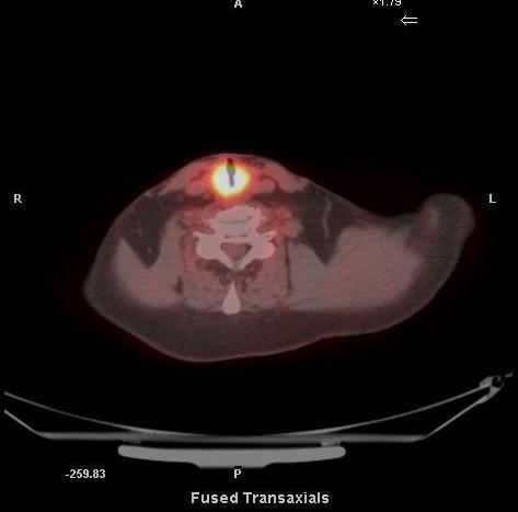 Recurrent Disease 64 year old man