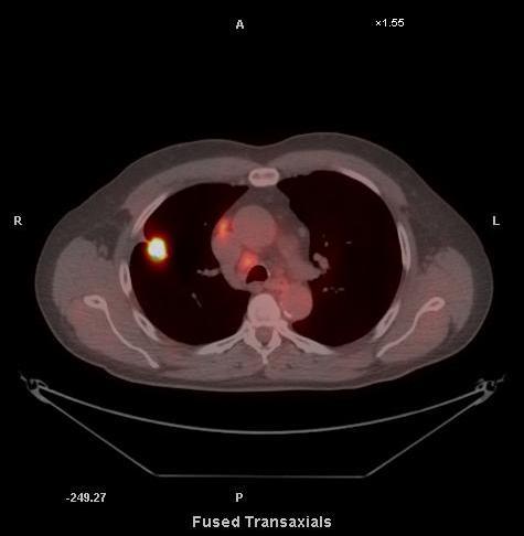 Monitoring Response 63 year old man stage 3A