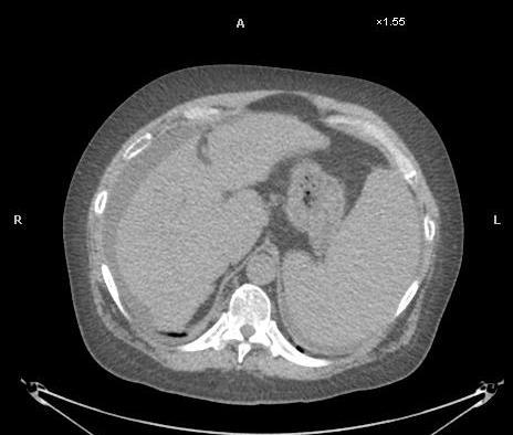 Standard CT PET/CT 56