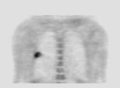 Infection 68 year old man with