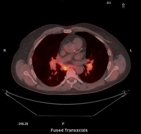 Granulomatous Disease 62 year old man with