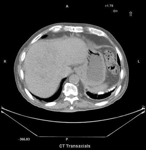 Adenoma 82 year old man
