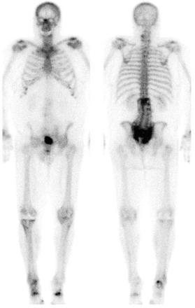 SPECT/CT Sacral Insufficiency Fracture Source: