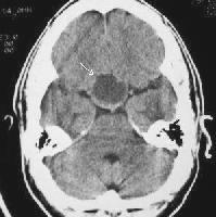 εγκεφαλικής αρτηρίας CT χωρίς σκιαστικό που δείχνει µια
