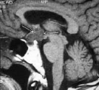 ετερογενώς MRI T1-ακολουθία χωρίς σκιαστικό που