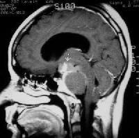 MRI µε σκιαστικό που δείχνει τα συµπαγή