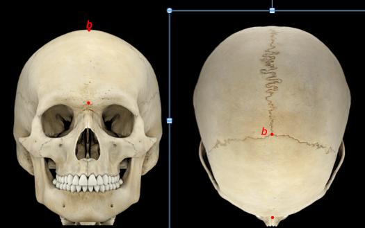 Διάκριση Αναφορικών Σημείων Τύπος Ι (ανατομικά αναφορικά σημεία) καθορίζονται από την ανατομία των οστών του κρανίου σημεία στα