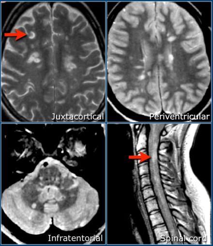 Εικόνα 21: Απεικόνιση βλαβών σε τμήματα του Εγκεφάλου και του Νωτιαίου Μυελού 9 Επιπρόσθετα, χρησιμοποιήθηκε η ιδιότητα του DisjoinWith για τις υποκλάσεις των υποκλάσεων Brain_Lesion_Type1,