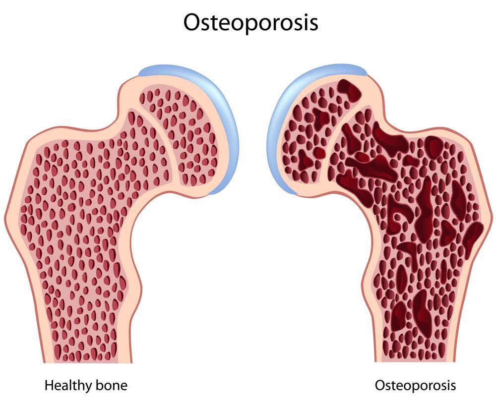 Πηγή: ΚΟΤΣΑΣΙΑΝ http://www.mayoclinic.