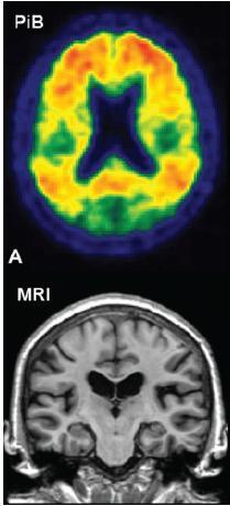 Group-wise separation for global cortical PiB and hippocampal W- score Το 33% των φυςιολογικϊν μαρτφρων εμφάνιςαν