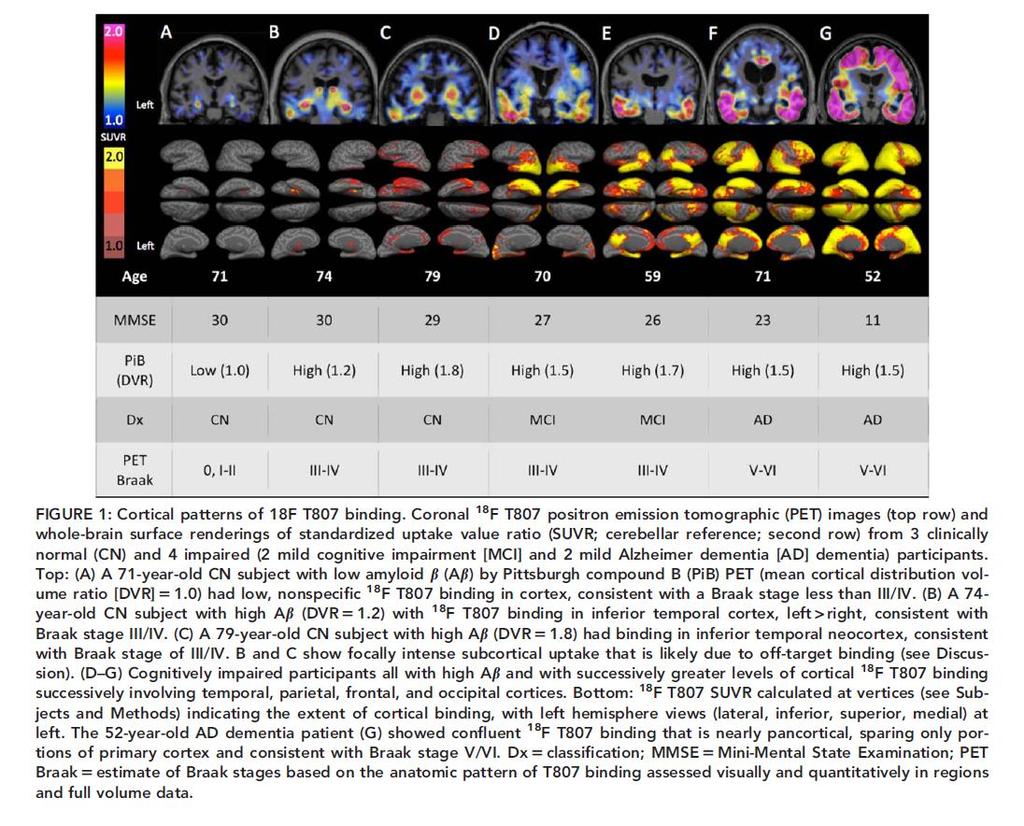 Tau Positron Emission Tomographic Imaging in Aging and Early Alzheimer Disease Keith A. Johnson, al and Reisa Sperling, ANN NEUROL 2016;79:110 119 TAU IMAGING: WHAT CAN IT TELL US?