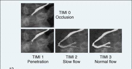 TIMI flow