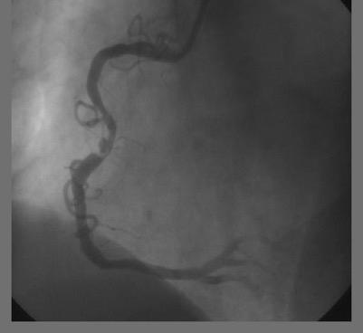 Angiography - an old and loyal friend 2D Longitudinal