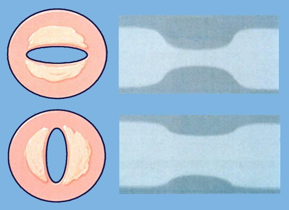 Limitations of Coronary Angiography