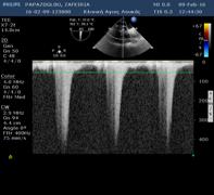 History 88 female Hypertensive -