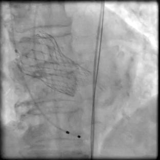 tamonade was noted; Aortogram showed intraannular