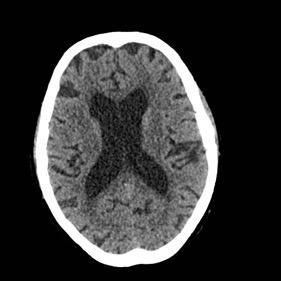 Patient was treated conservatively with pericardial drainage, heparin reversal, interruption of all antithrombotics-