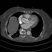 In consultation with cardiac surgeons and getting advice from TAVI forum, we did not start any