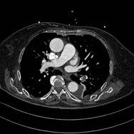 6, patient developed TIA with dysphasia, CT was normal; started on Aspirin and TIA resolved completely.