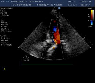 Subcutaneous heparin is stopped; patient remains on long term aspirin 2D echo 2