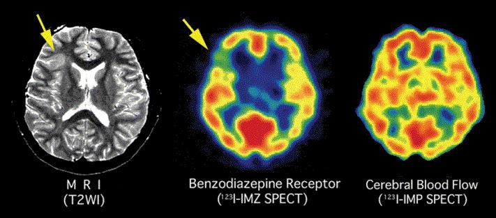 epileptogenesis: basic mechanisms and