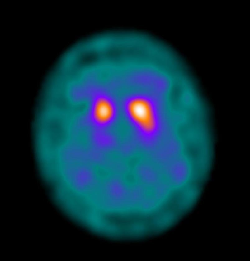 SPECT σπινθηρογράφημα βασικών γαγγλίων με 123 Ι-ioflupane (DaTSCAN) σε ασθενή με ιδιοπαθή νόσο Parkinson: παρατηρείται