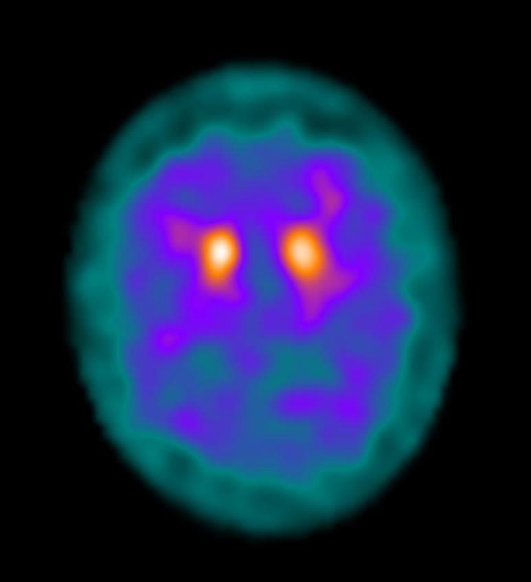 SPECT σπινθηρογράφημα βασικών γαγγλίων με 123 Ι-ioflupane (DaTSCAN) σε ασθενή με παρκινσονισμό προχωρημένου σταδίου: μειωμένη καθήλωση στο κέλυφος του φακοειδούς πυρήνα αμφοτερόπλευρα,