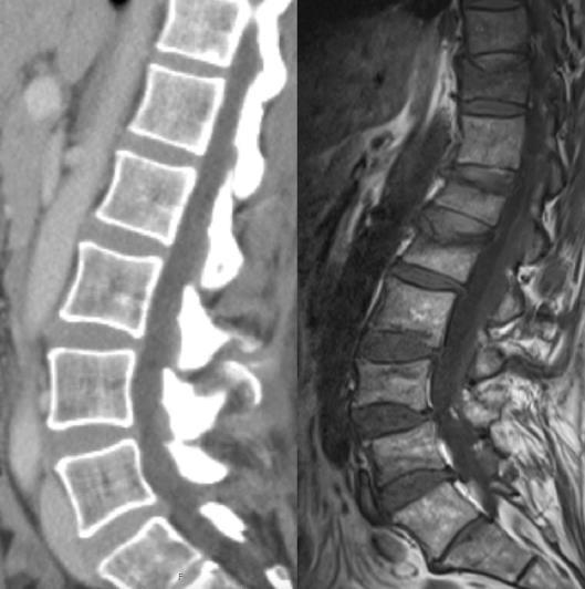 Rebound-associated vertebral fractures after discontinuation of denosumab from clinic and biomechanics Η μεγάλη αύξηση του ρυθμού οστικής εναλλαγής σαν αποτέλεσμα ισχυρής αντιοστεοκλαστικής αγωγής θα