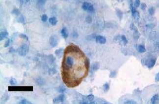 Εικόνα 1. HLA-G θετικό κυτοτροφοβλαστικό κύτταρο σε διατραχηλικό δείγμα. Η αντικειμενοφόρος ετοιμάστηκε όπως περιγράφεται από τους Imudia et al.