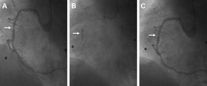 Coronary angiography reveals a 90% stenosis of the right coronary artery (RCA) (A).