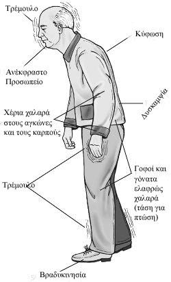 ΚΛΙΝΙΚΗ ΕΙΚΟΝΑ ΤΗΣ ΝΟΣΟΥ ΠΑΡΚΙΝΣΟΝ ΚΙΝΗΤΙΚΑ ΠΡΟΒΛΗΜΑΤΑ ΚΑΤΑΘΛΙΨΗ