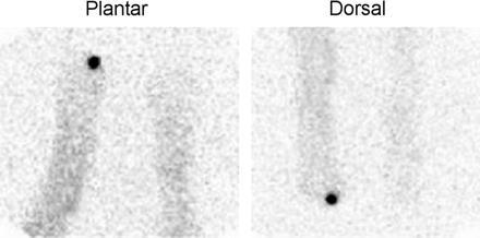 Διαβητικό πόδι - Οστεομυελίτιδα Fanolesomab (1h) Source: Love C & Palestro CJ.