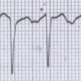 V1, (-) I, avl RA AT: P wave: (-) V1, (+)