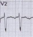 anatomy P Wave morphology algorithm : 93%