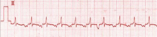 IV adenosine 6+12+18mg