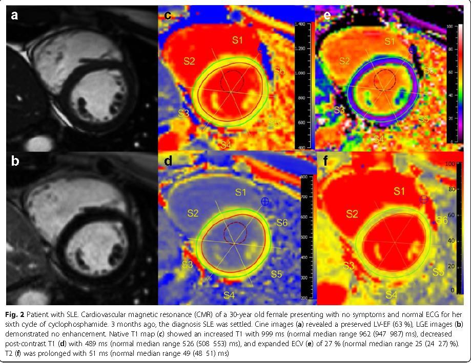 Evaluation of myocardial involvement in patients with connective