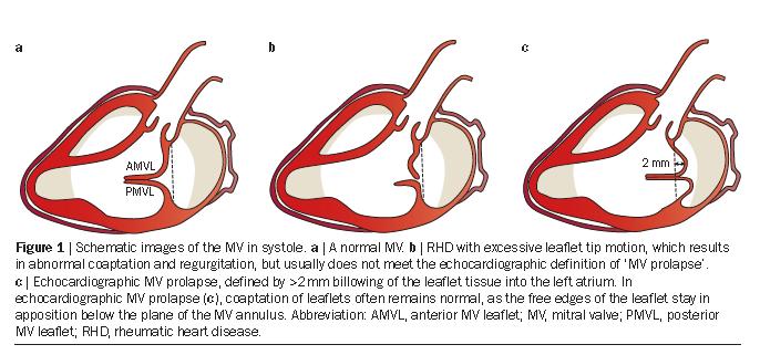 World Heart Federation criteria for echocardiographic diagnosis of rheumatic heart disease an evidence-based guideline Excessive MV leaflet tip motion of the AMVL or posterior MV leaflet is