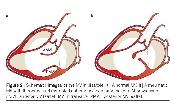 World Heart Federation criteria for echocardiographic diagnosis of rheumatic heart disease Restricted MV leaflet motion is present in 20 60% of patients.