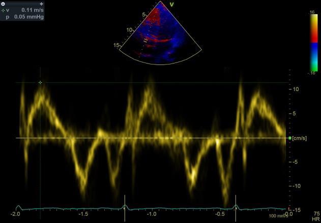 Mitral