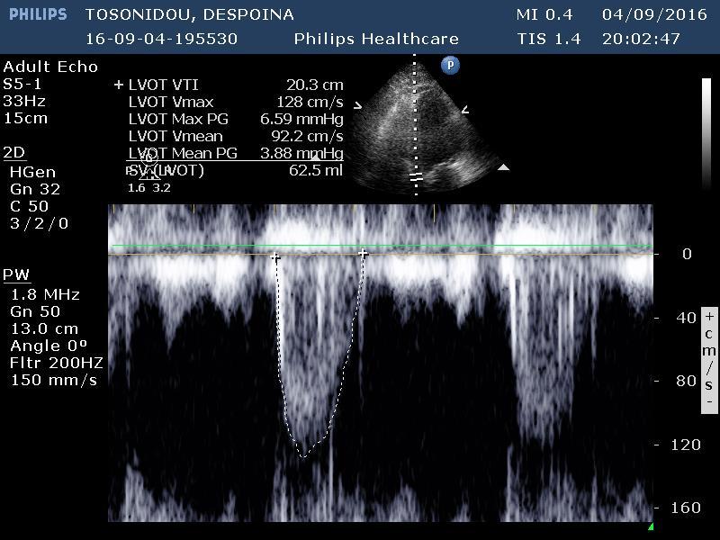 Stroke volume =62,5 ml End diastolic and/ or end systolic volume increase despite a normal or elevated