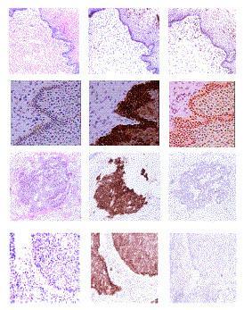 HPV strategies to avoid immune recognition: suppression Repression of TLR9 (signal