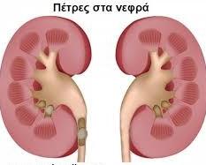 Μια πέτρα στα νεφρά είναι πιθανό να μην προκαλέσει συμπτώματα μέχρι να κινηθεί μέσα στο νεφρό ή να περάσει στον ουρητήρα, τον σωλήνα που συνδέει το νεφρό και την ουροδόχο κύστη.