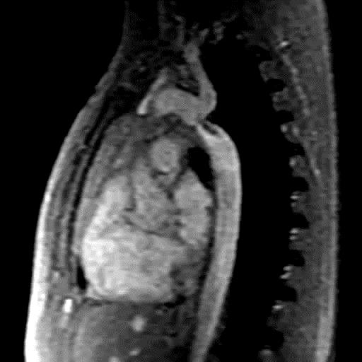 Στένωση ισθμού αορτής (Coarctation of Aorta CoA) Η πλειονότητα έχει